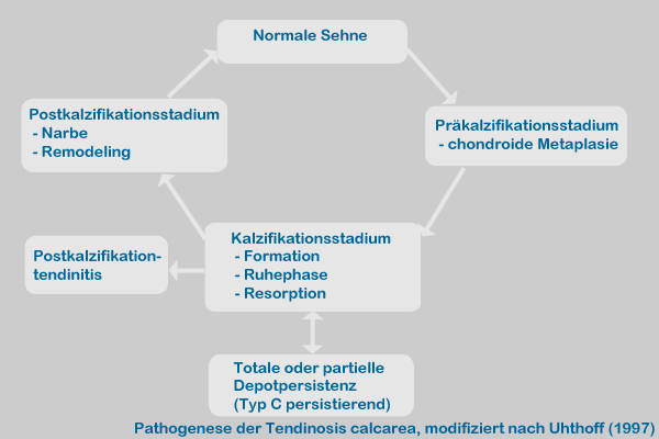 Tendinosis calcarea nach Uthoff