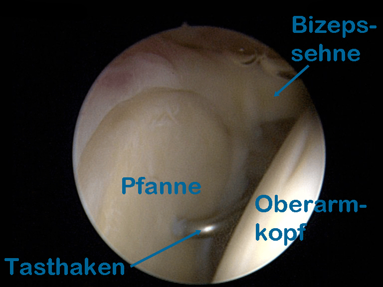 Glenoid