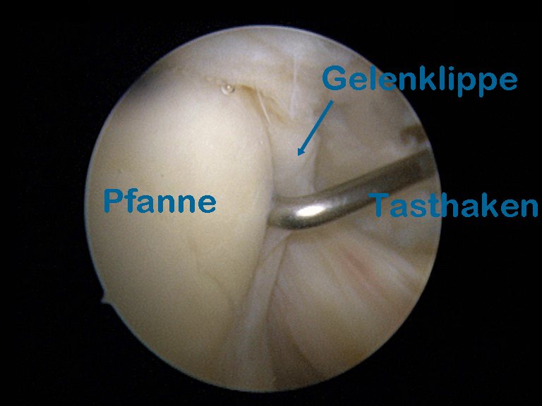 anteriores labrum