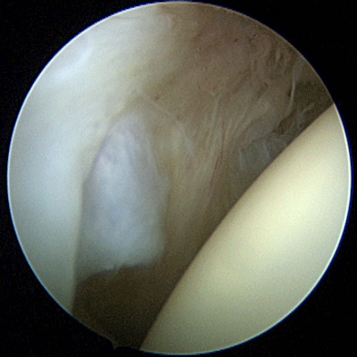 Glenoid