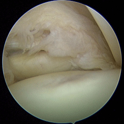 anteriores labrum